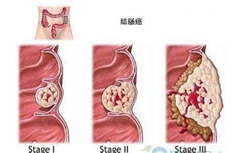 结肠癌的早期症状及表现