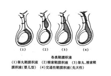 睾丸鞘膜积液是怎么引起的