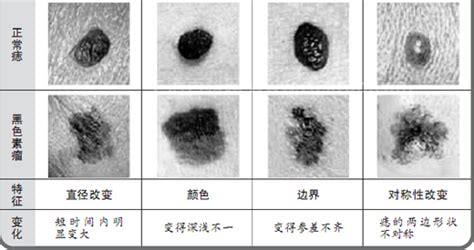 黑色素瘤和黑痣的区别