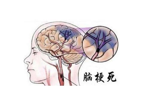 脑梗塞和脑梗死的区别