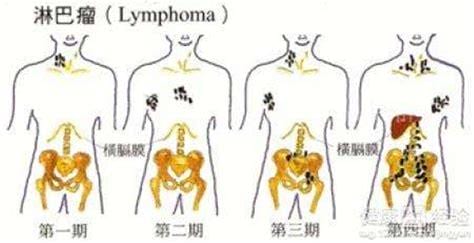 淋巴癌早期症状