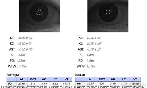 右眼复合AL22.53mm，左眼复合AL23.60