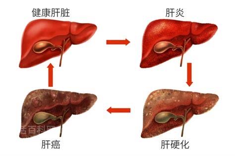 肝衰竭中期能治好吗