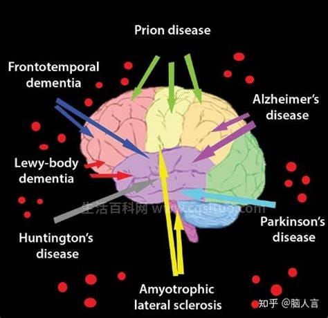 神经退行性疾病伴脑铁沉积6型是什