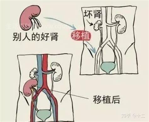 什么是活体肾移植