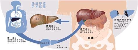 活体肝移植是怎么回事