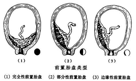 什么是中央性前置胎盘