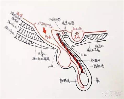 运动型疝气是什么病