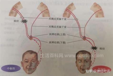 麻痹是什么意思