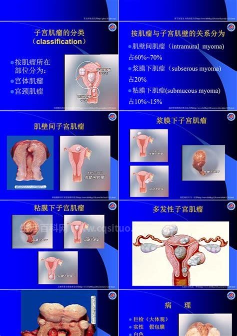 子宫肌瘤患者最主要的症状是