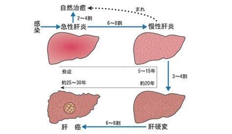 什么是急性肝炎