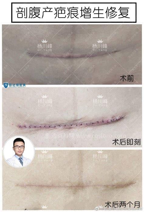 剖腹产瘢痕怎么去除