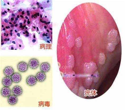 肛门口有个软软的肉疙瘩是什么