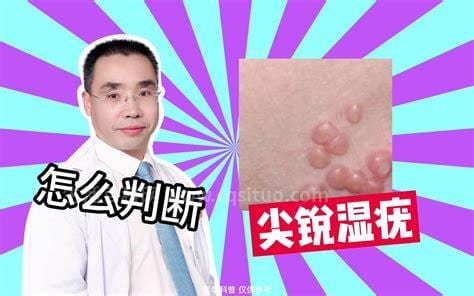 尖锐湿疣是性病吗