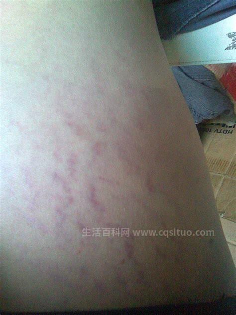 大腿根外侧有红色条纹，不痛不痒是怎