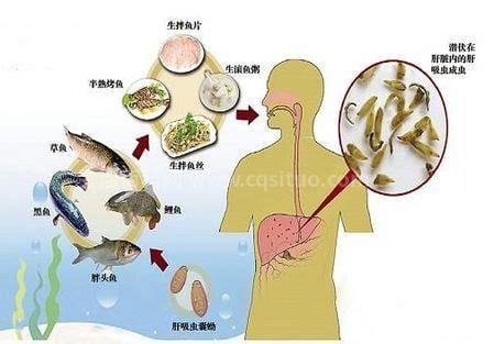 肝吸虫病症状