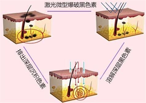 激光治疗黄褐斑原理