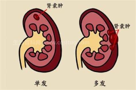 双肾囊肿怎么治疗