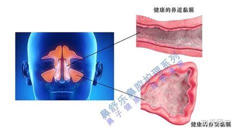 鼻屎是怎么形成的