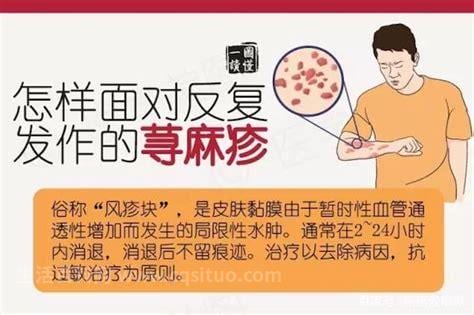 麻疹的症状和治疗