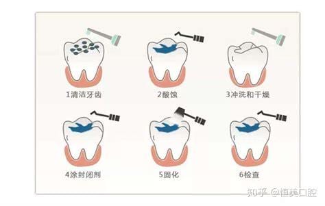 龋齿是怎么形成的