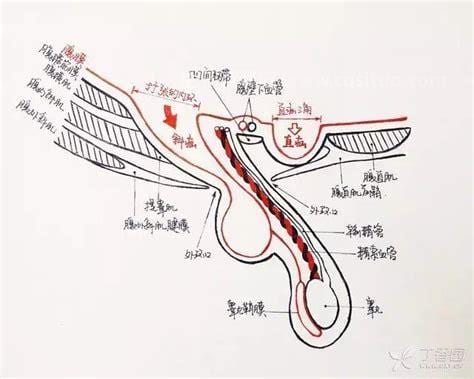 运动型疝气怎么恢复