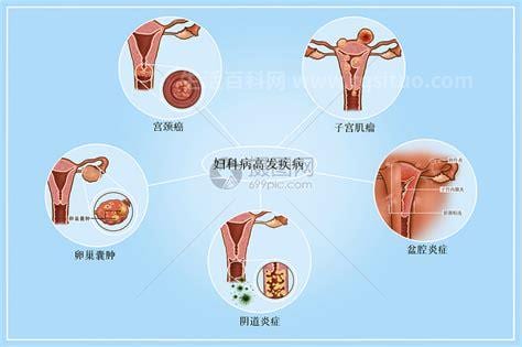 妇科病的治疗