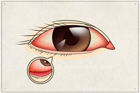 红眼病怎么传染他人