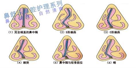 鼻子堵塞怎么睡觉