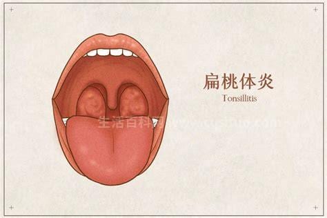 扁桃体发炎要吃什么