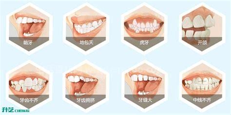 牙列不齐的分类有哪些