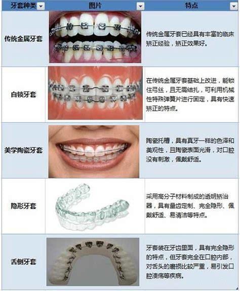 牙套的具体类型有哪些