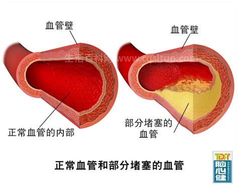 动脉硬化表现