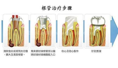 牙髓炎必须做根管治疗吗