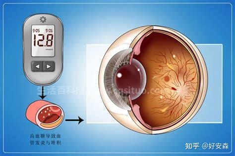 糖尿病患者容易出现哪些眼部疾病