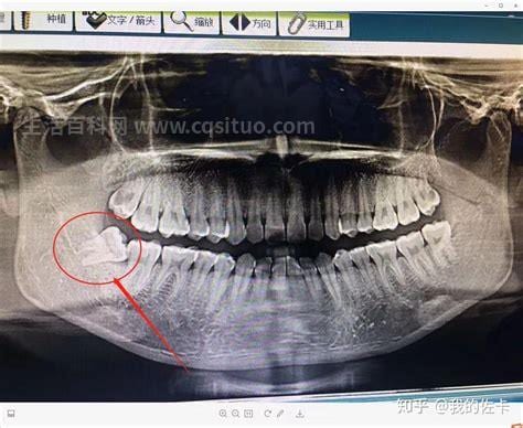 拔智齿去哪个科室