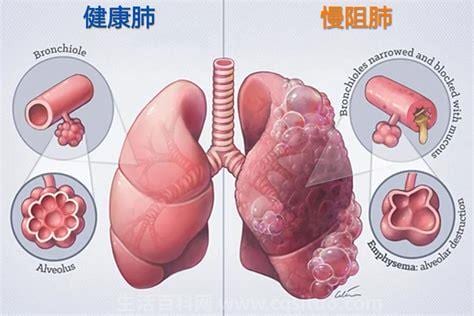 慢阻肺是什么病