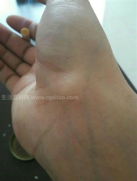 手腕腱鞘炎是什么症状