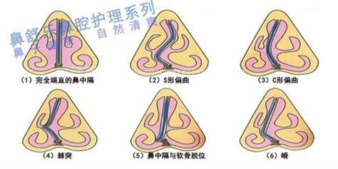 鼻中隔偏曲手术如何做