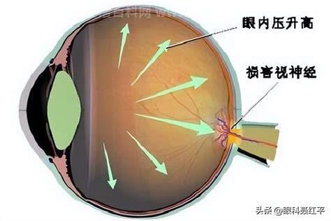 怎样治疗眼压高