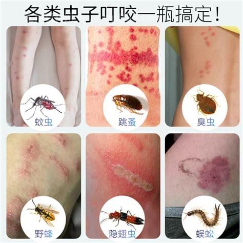 被蚊子咬了用什么药