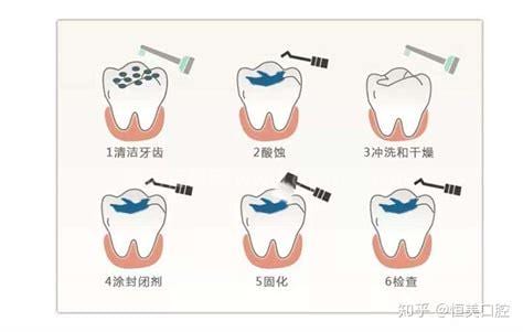 龋齿是什么意思