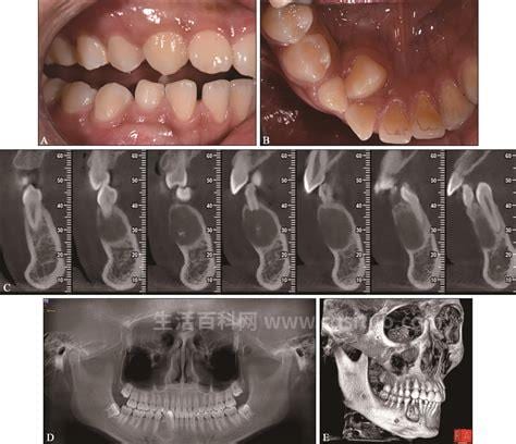 牙骨质瘤是怎么回事