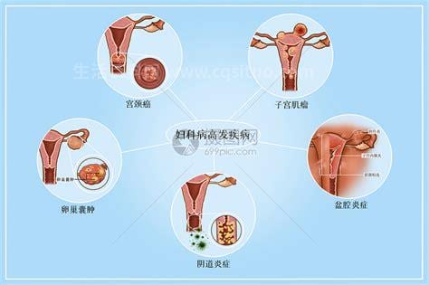 妇科疾病的征兆是什么