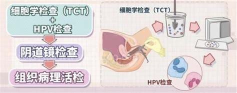 宫颈hpv感染治疗方法