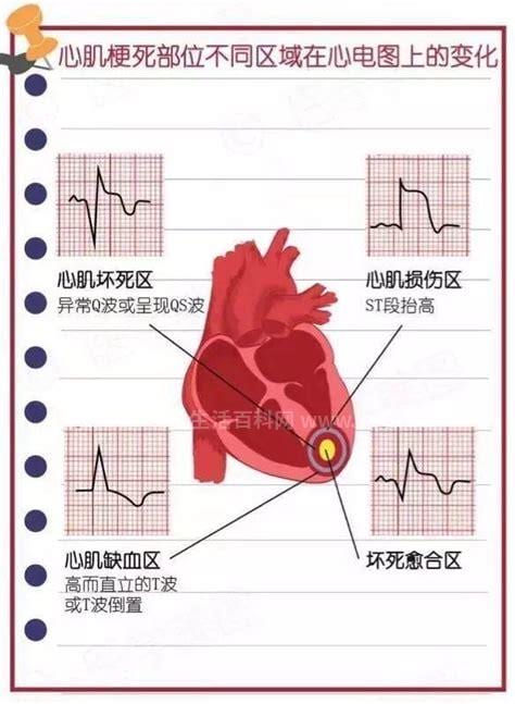 心肌梗塞心电图表现有几种