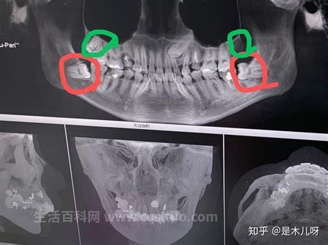 智齿是什么样子的