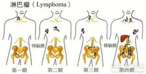 淋巴癌的症状都有什么