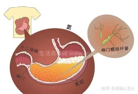 幽门螺杆菌多少算严重