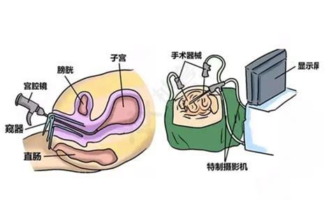 宫腔镜检查手术步骤